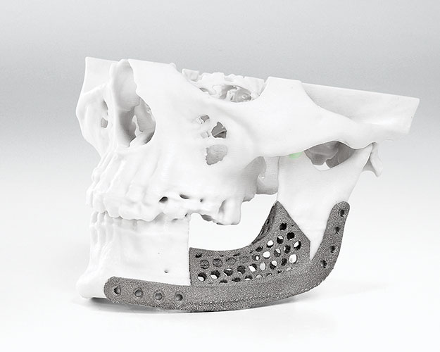 Reconstruction of left mandible