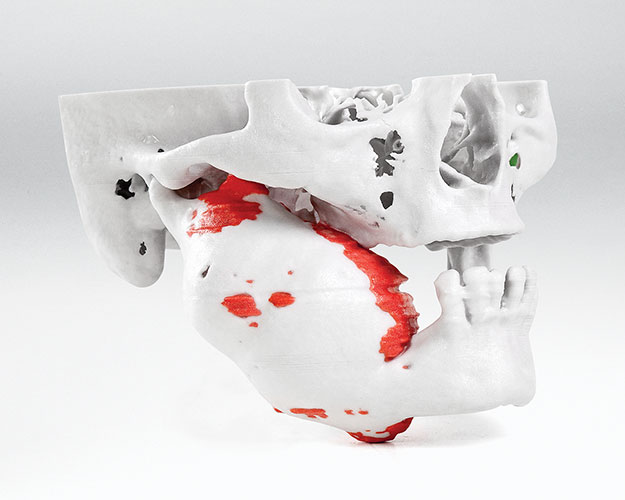 Patient's skull model