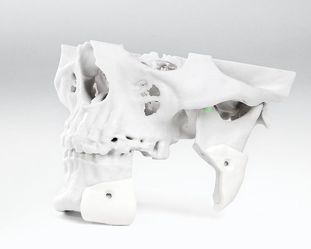 Patient specific surgical cutting guides