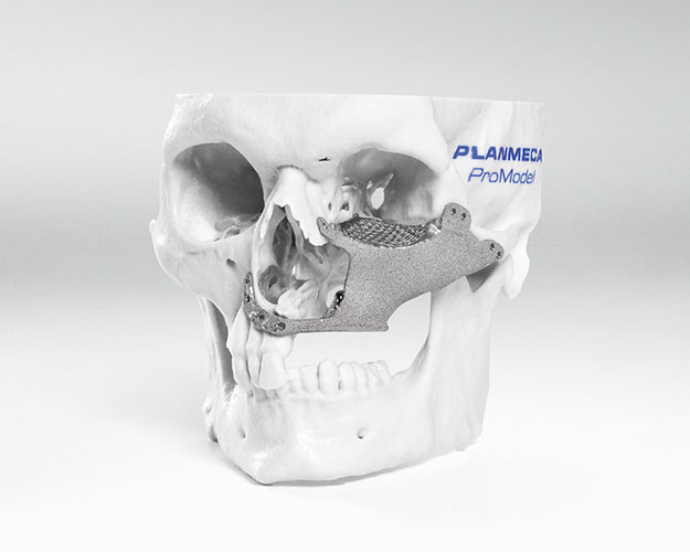 Left part of maxilla reconstructed after tumour removal