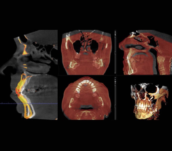 普兰梅卡 Planmeca Romexis 重叠 CBCT 影像